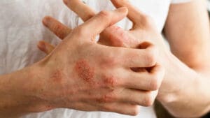 Eczema & Psoriasis