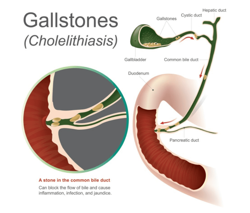 Gallstones (Cholelithiasis)